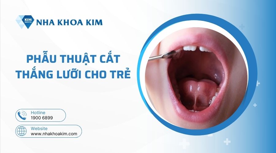 Trẻ bị dính thắng lưỡi nên làm gì?