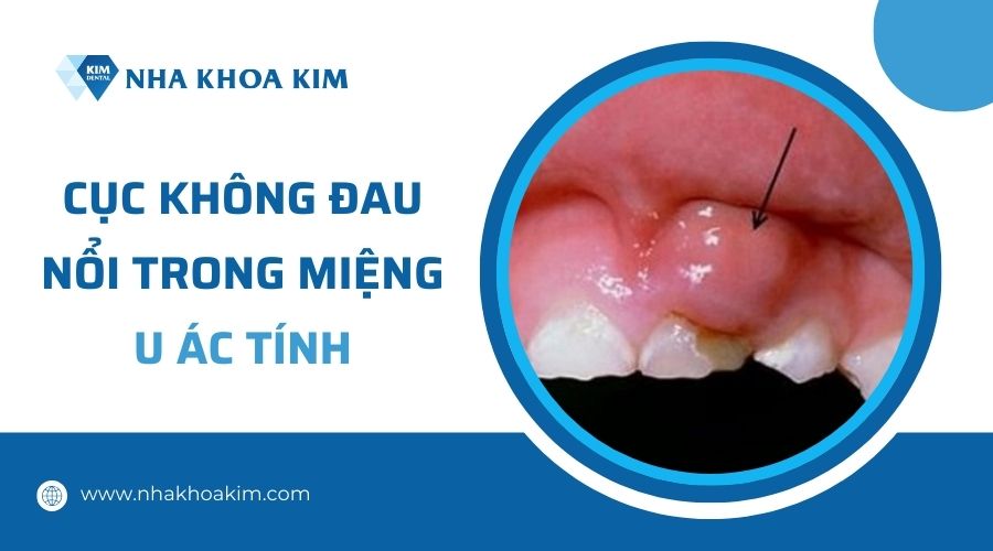 Nguyên nhân nổi cục trong miệng không đau