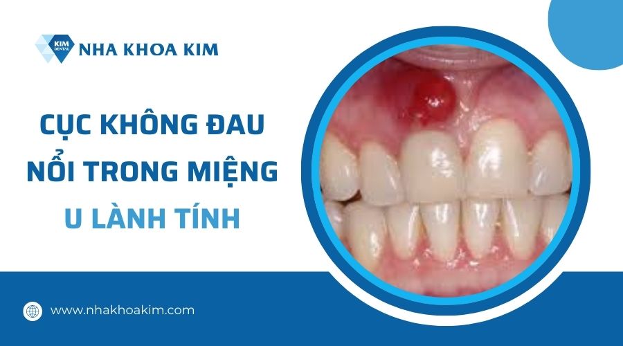 Tại sao nổi cục không đau trong miệng?