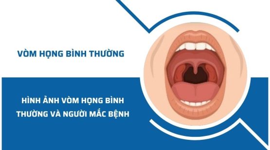 Hình ảnh nhận biết vòm họng bình thường và người mắc bệnh