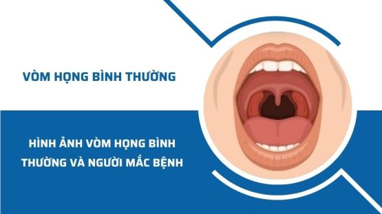 Hình ảnh nhận biết vòm họng bình thường và người mắc bệnh