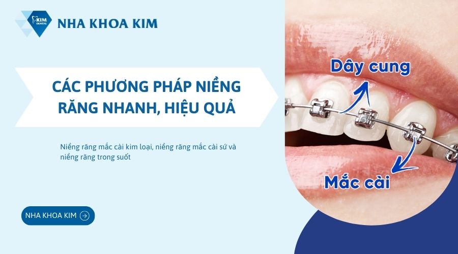 Phương pháp niềng răng nhanh, hiệu quả