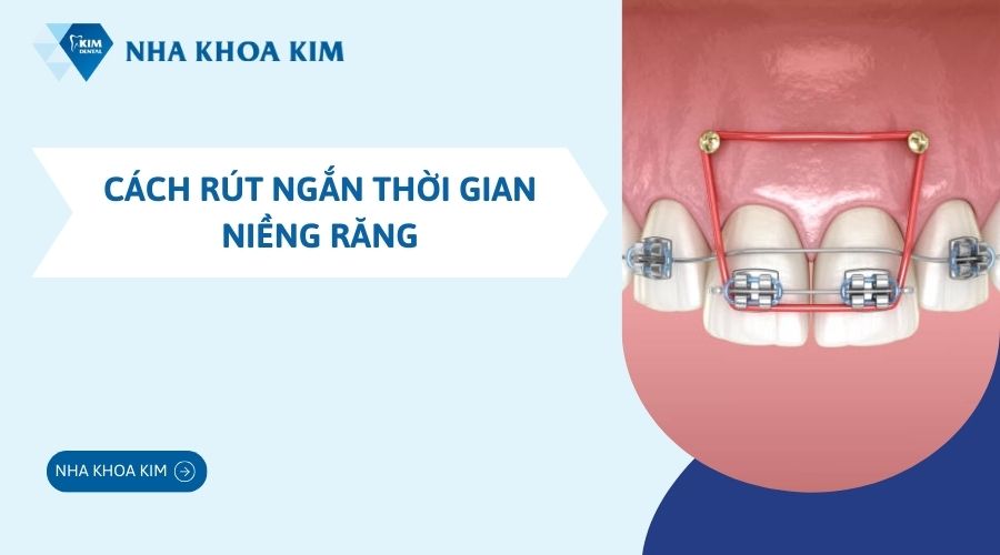 Cách rút ngắn thời gian niềng răng