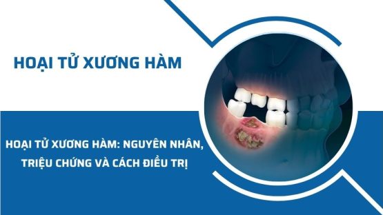 Hoại tử xương hàm: Nguyên nhân, triệu chứng và cách điều trị