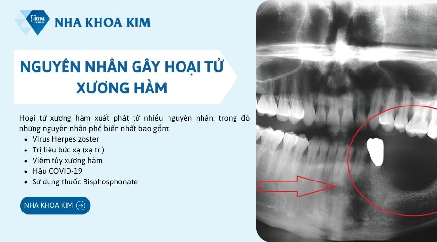 Nguyên nhân gây hoại tử xương hàm
