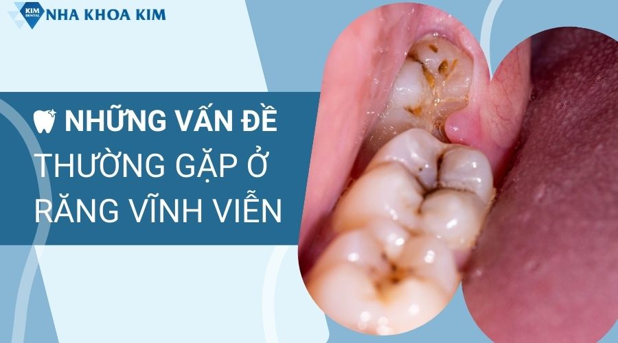 Những vấn đề thường gặp ở răng vĩnh viễn