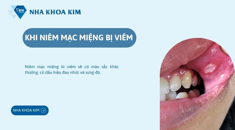Niêm mạc miệng bị viêm
