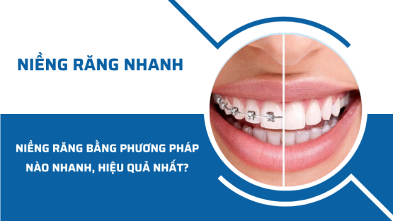 Niềng răng bằng phương pháp nào nhanh, hiệu quả nhất?