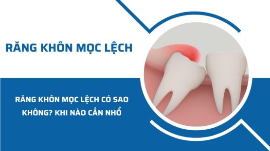 Răng khôn mọc lệch có sao không? Khi nào cần nhổ