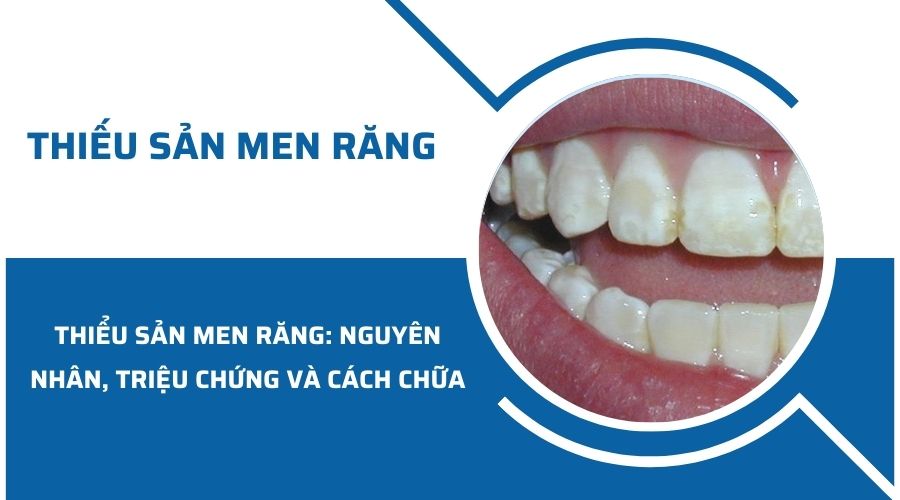 Thiếu sản men răng: Nguyên nhân, triệu chứng và cách chữa