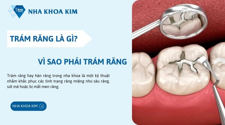 Trám răng là gì
