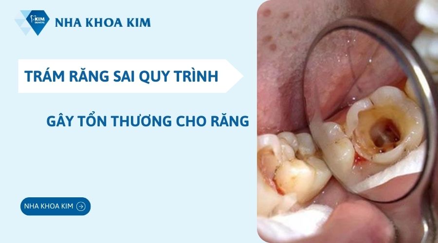Các tác hại của trám răng sai quy trình