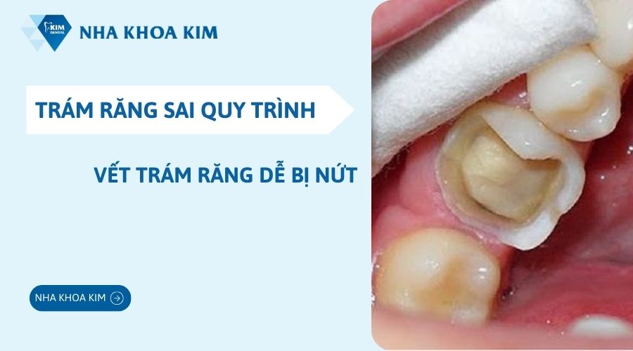 Trám răng sai quy trình gây kích thích lên mô nướu