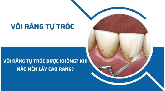 Vôi răng tự tróc được không? Khi nào nên lấy cao răng?