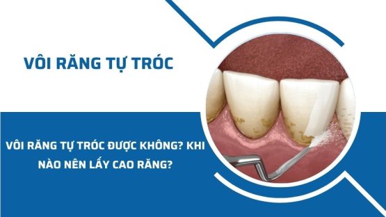 Vôi răng tự tróc được không? Khi nào nên lấy cao răng?