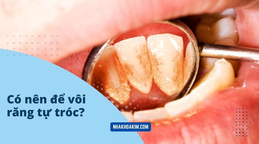Có nên để vôi răng tự tróc không?