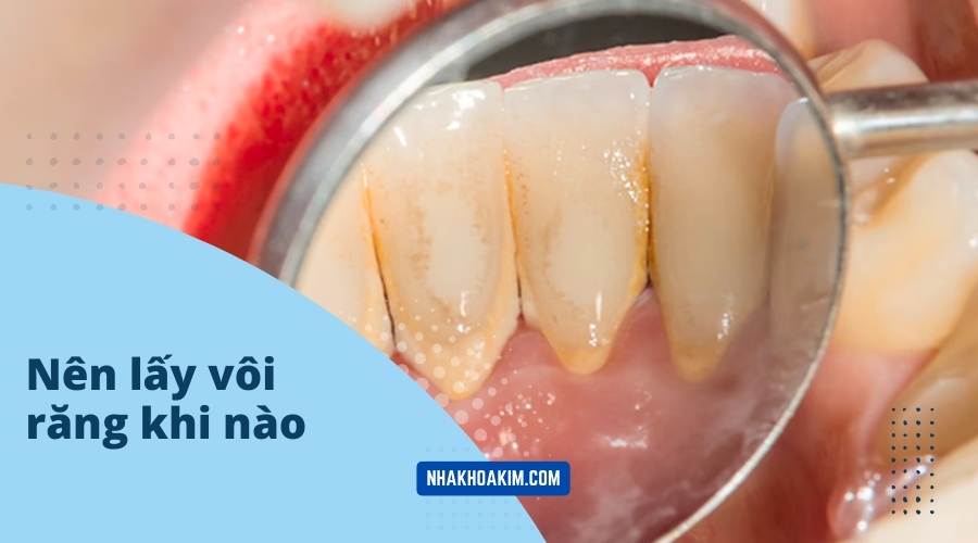 Nên lấy vôi răng khi nào?