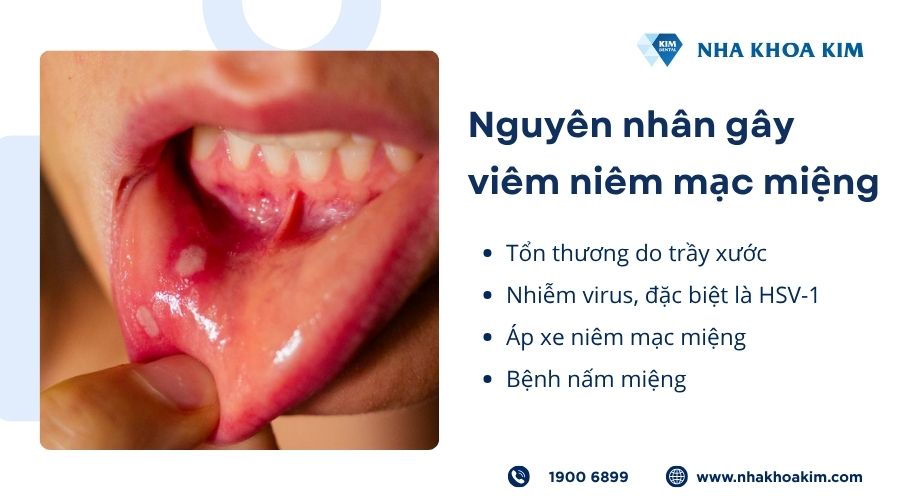 Nguyên nhân gây viêm niêm mạc miệng