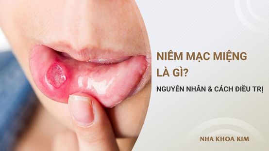Niêm mạc miệng là gì? Nguyên nhân gây viêm và cách điều trị