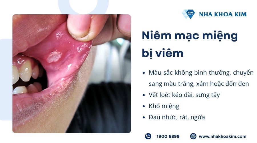 Niêm mạc miệng bị viêm