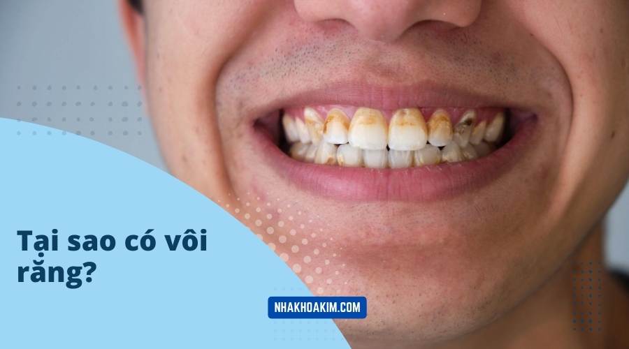 Tại sao lại có vôi răng?