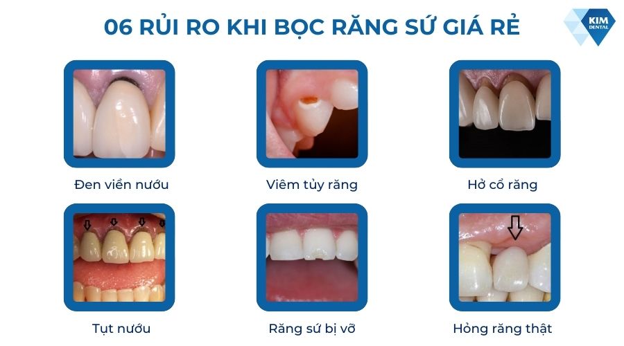 Bọc răng sứ 500k có nguy hiểm không?