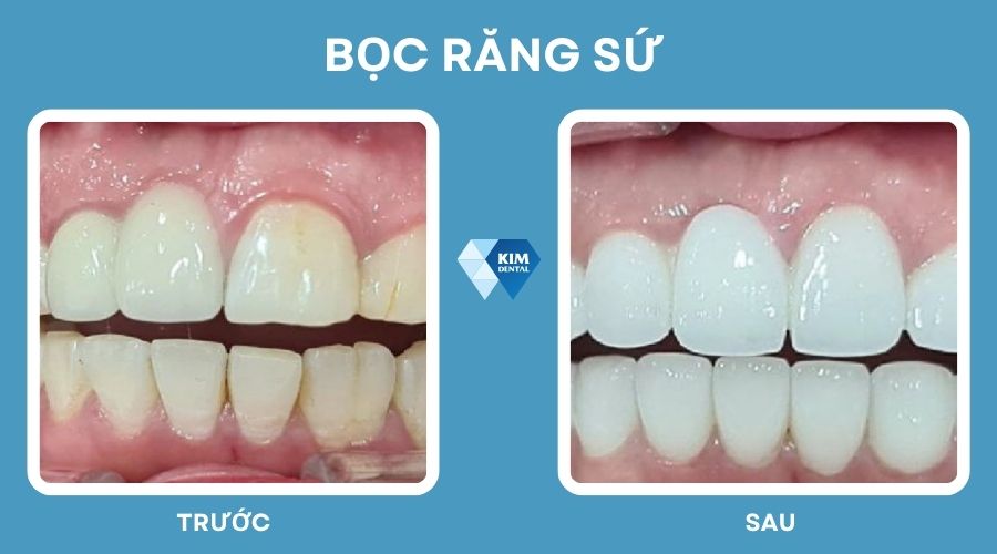 Bọc răng sứ để có nụ cười đẹp hơn