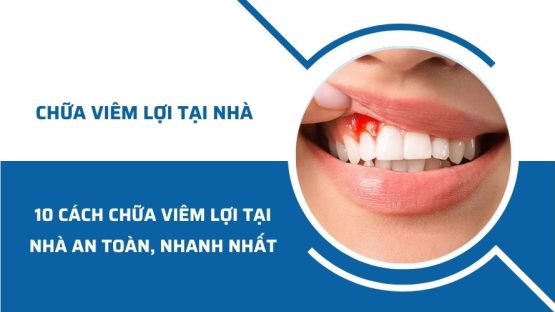 10 cách chữa viêm lợi tại nhà an toàn, nhanh nhất