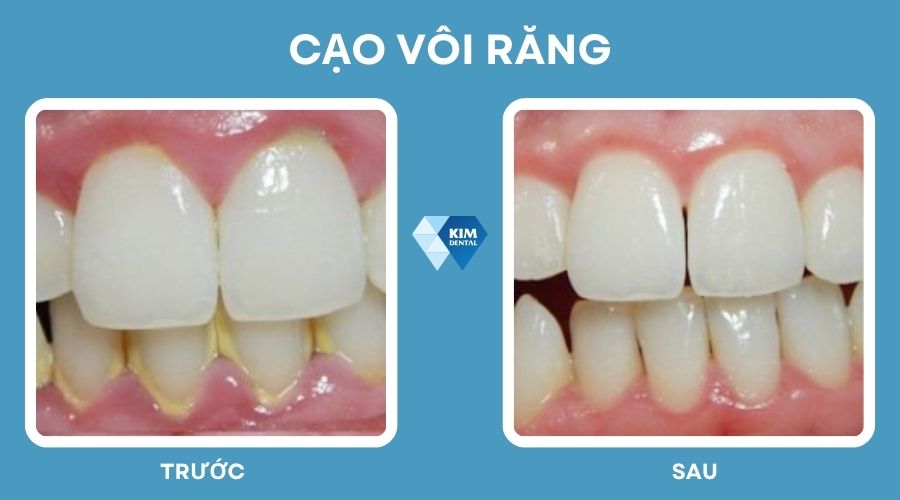 Cạo vôi răng giúp sở hữu nụ đẹp trắng sáng