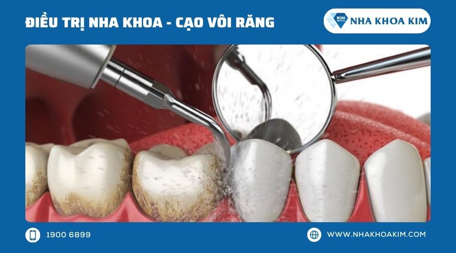 Cạo vôi răng trị sưng nướu răng