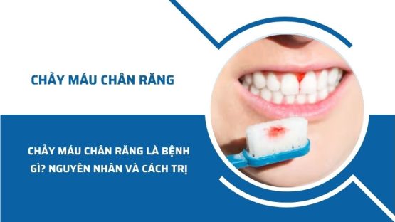 Chảy máu chân răng là bệnh gì? Nguyên nhân và cách trị