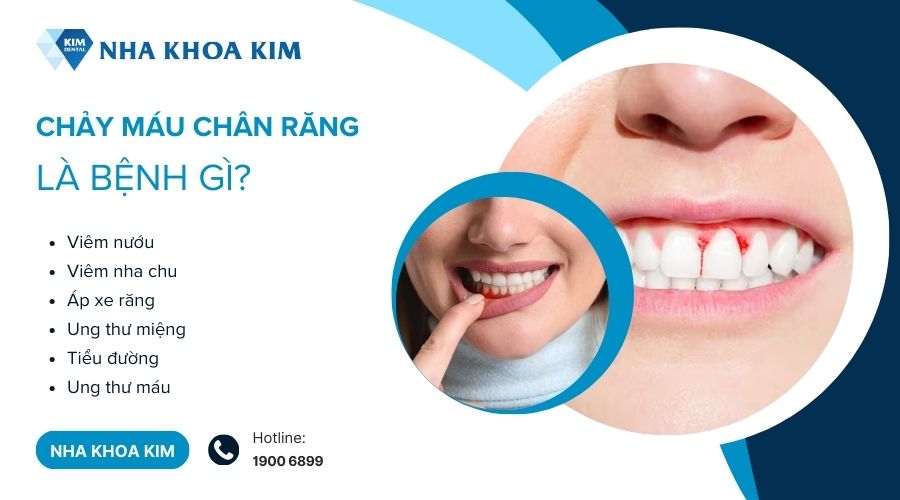 Chảy máu chân răng là bệnh gì?