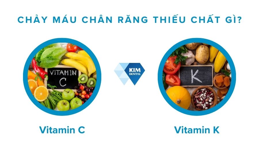 Chảy máu chân răng là thiếu chất gì?