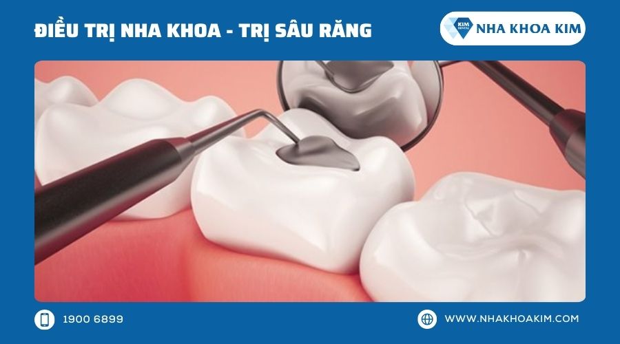 Chữa sưng lợi hàm trên bằng cách điều trị sâu răng