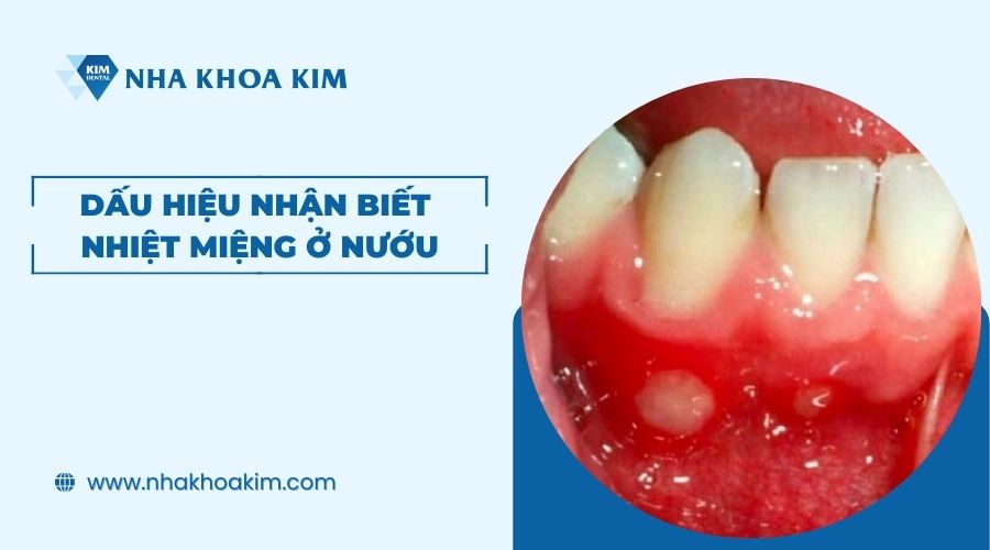 Dấu hiệu nhận biết nhiệt miệng ở nướu