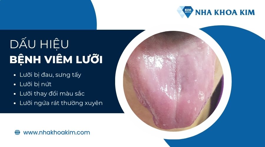 Dấu hiệu viêm lưỡi