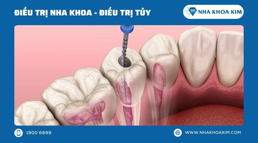 Điều trị tủy răng hàm trên