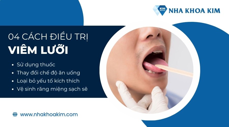 Cách điều trị viêm lưỡi