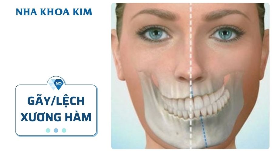 Gãy, lệch xương hàm mặt