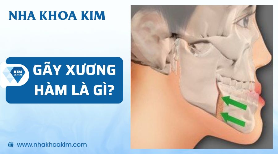 Gãy xương hàm là gì?