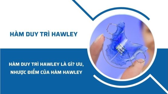 Hàm duy trì Hawley là gì? Ưu và nhược điểm của hàm hawley