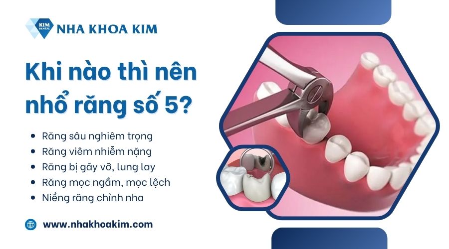 Khi nào thì nên nhổ răng số 5?