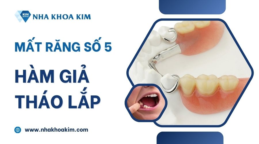 Khôi phục răng số 5 bằng hàm giả tháo lắp