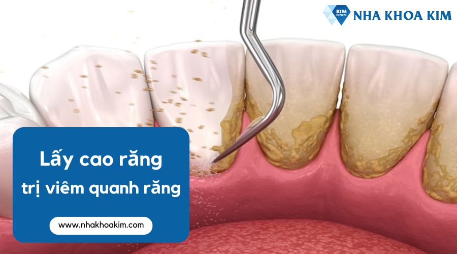 Cách điều trị viêm quanh răng