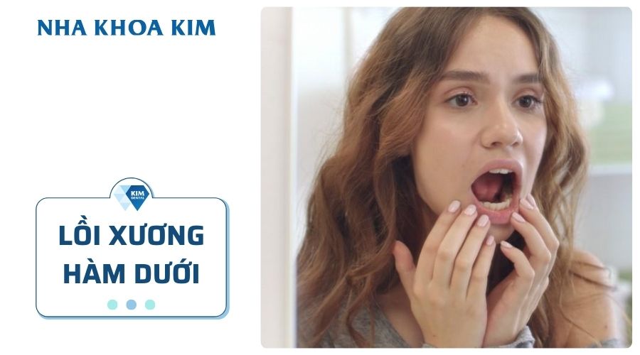 Lồi xương hàm dưới