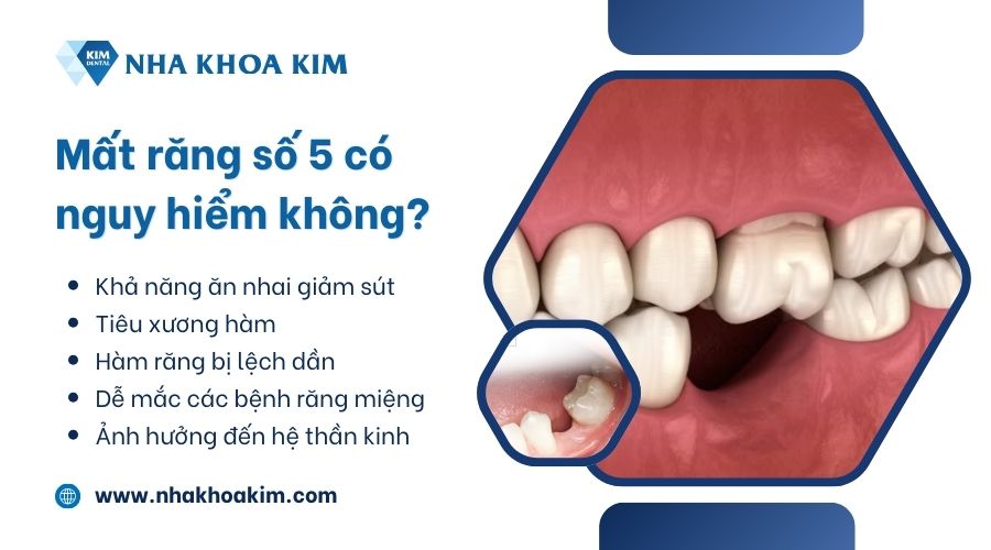 Mất răng số 5 có nguy hiểm không?