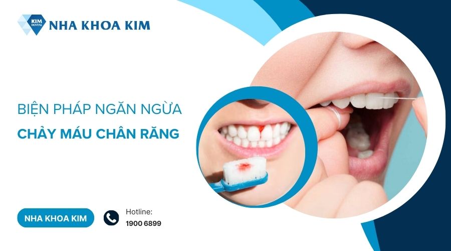 Biện pháp ngăn ngừa chảy máu chân răng