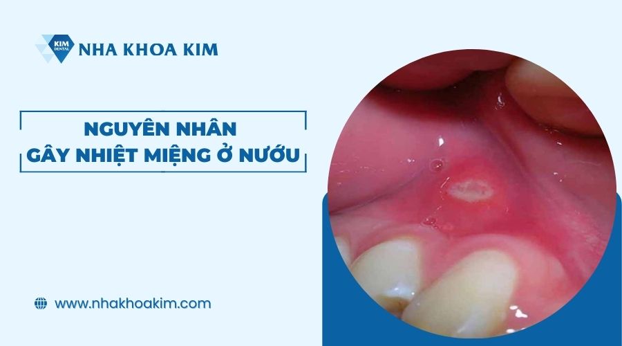 Nguyên nhân gây nhiệt miệng ở nướu