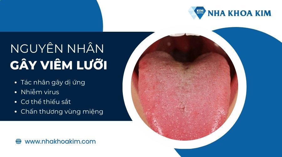 Nguyên nhân gây viêm lưỡi