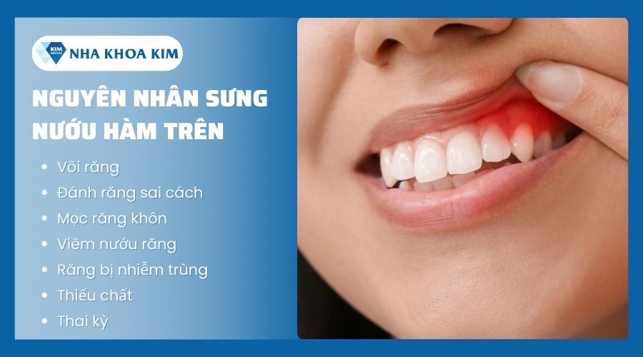 Nguyên nhân gây sưng nướu răng hàm trên